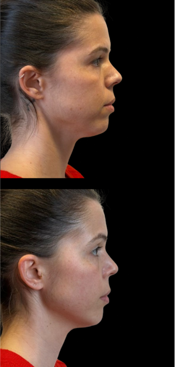 case 2a face